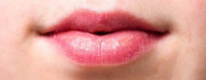 tipps gegen rissige Lippen